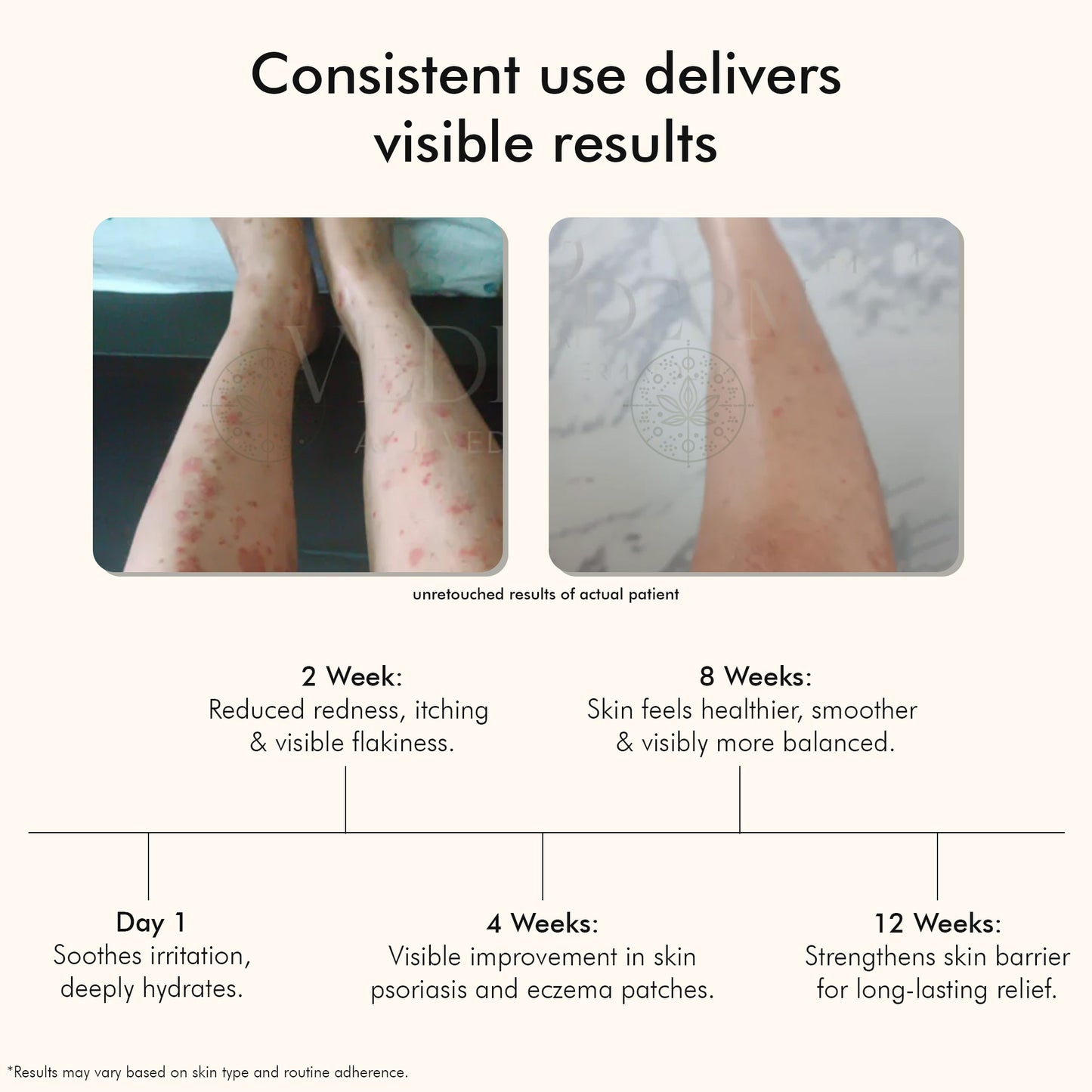 Vedicderm Psoriasis Cream with 2% Bakuchi Extract - New and Improved Formula