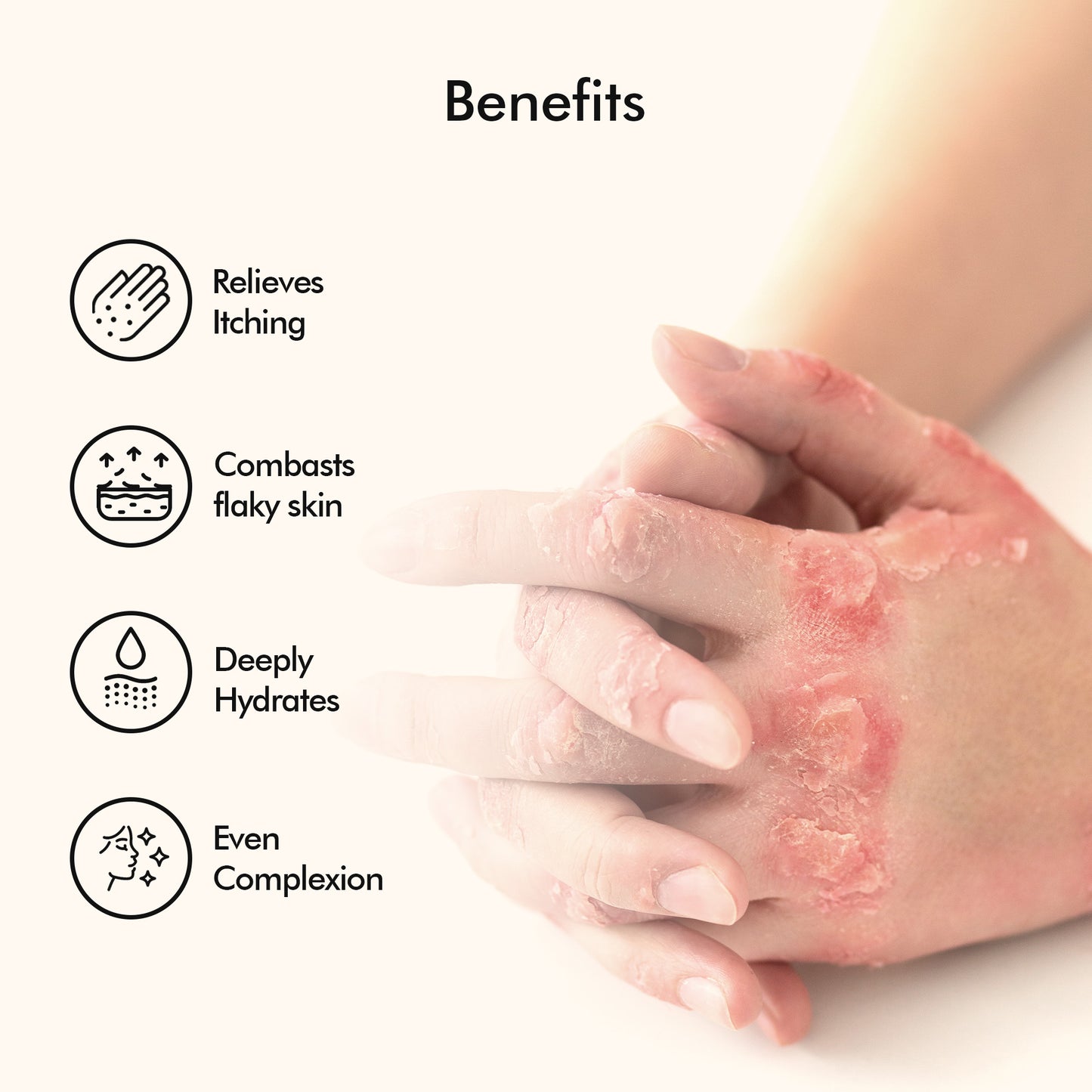 Vedicderm Psoriasis Cream with 2% Bakuchi Extract
