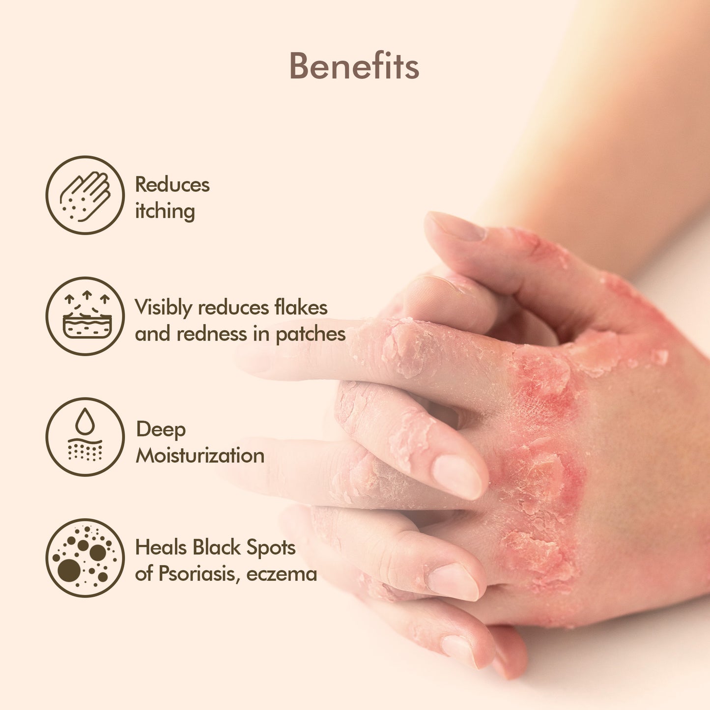 Oleander's Oil for Psoriasis, Eczema, Atopic Dermatitis