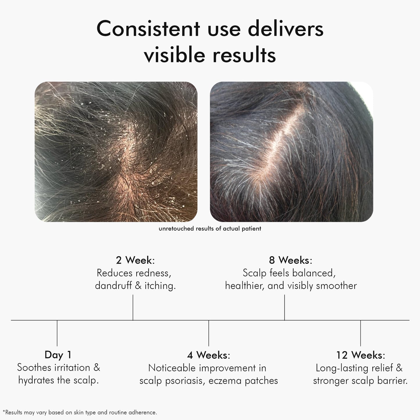 Plasma Bamboo Charcoal Shampoo for Psoriasis & Sensitive Scalp