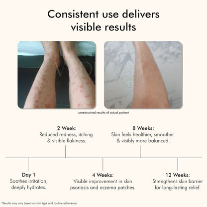 Vedicderm Psoriasis Cream with 2% Bakuchi Extract - New and Improved Formula