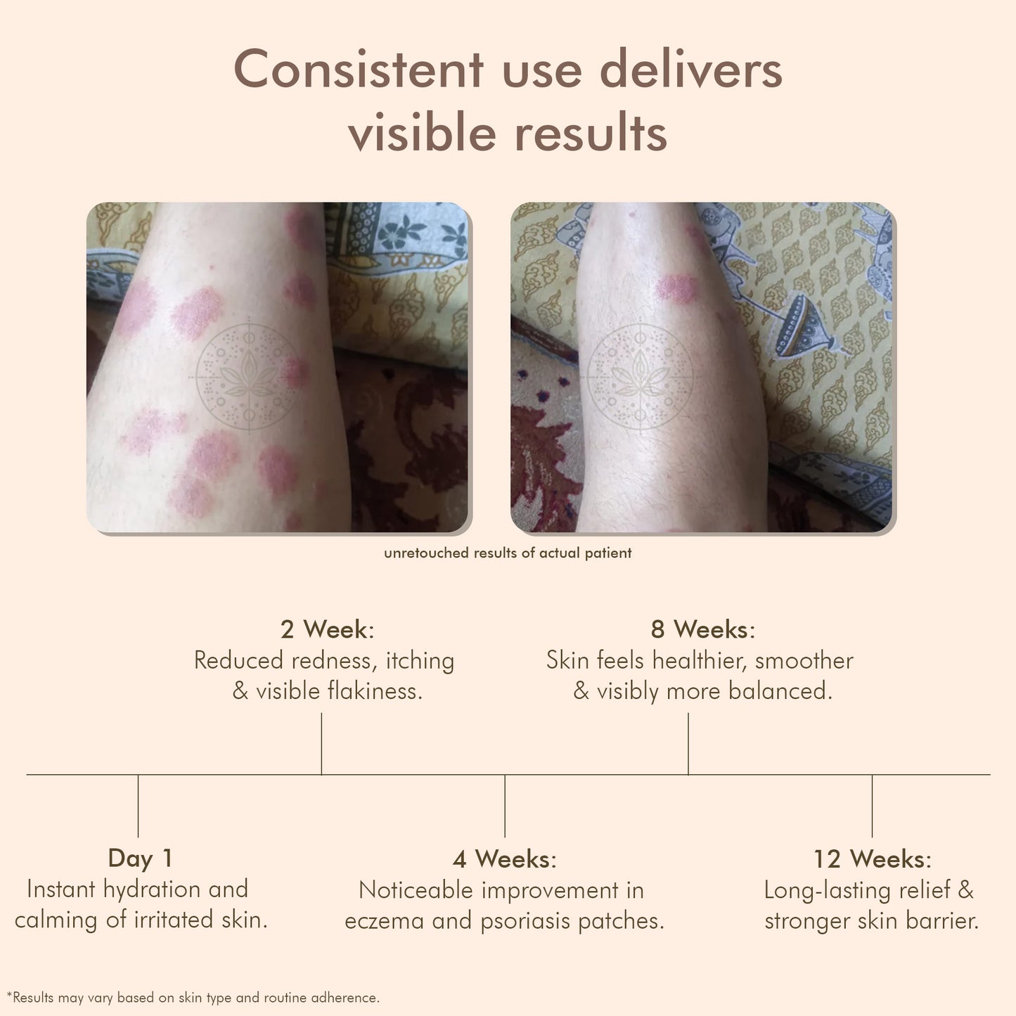 Oleander's Oil for Psoriasis, Eczema, and Atopic Dermatitis