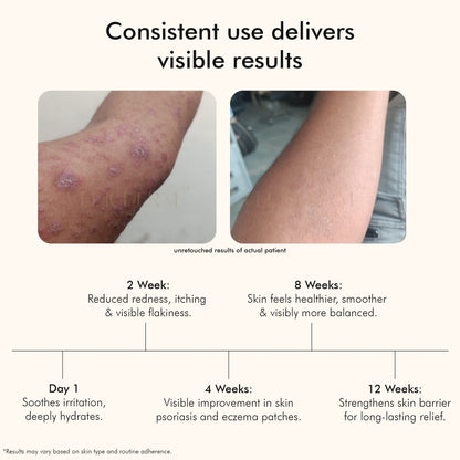 Vedicderm Psoriasis Cream with 2% Bakuchi Extract
