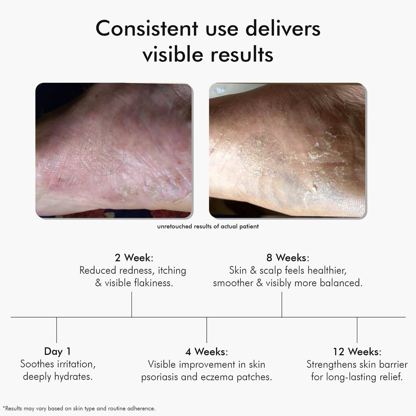 Vedicderm Ultimate Psoriasis Care Bundle