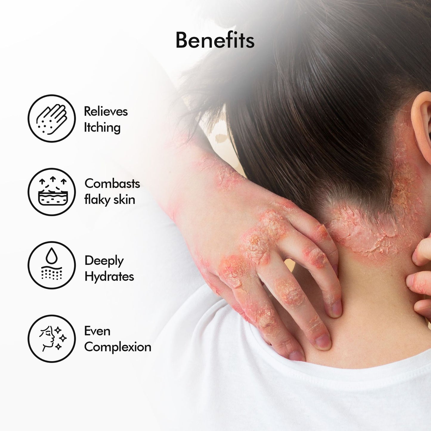 Vedicderm Ultimate Psoriasis Care Bundle