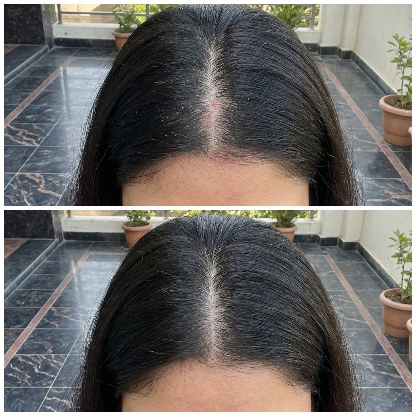 Vedicderm Psoriasis Oil | 2-in-1 Skin + Scalp Relief Oil