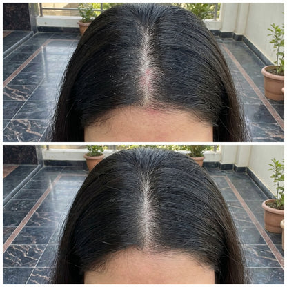 Vedicderm Psoriasis Oil | 2-in-1 Skin + Scalp Relief Oil