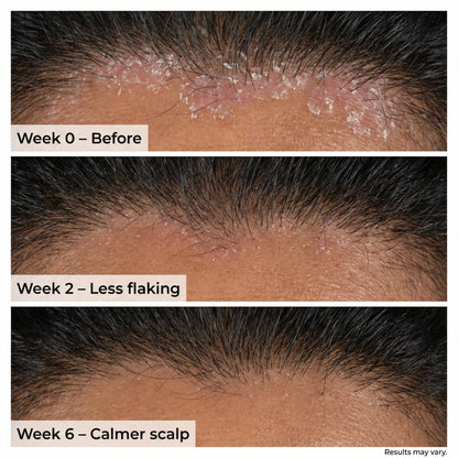 Sensitive Scalp Bundle for Psoriasis, Dandruff, & Itchy Scalp