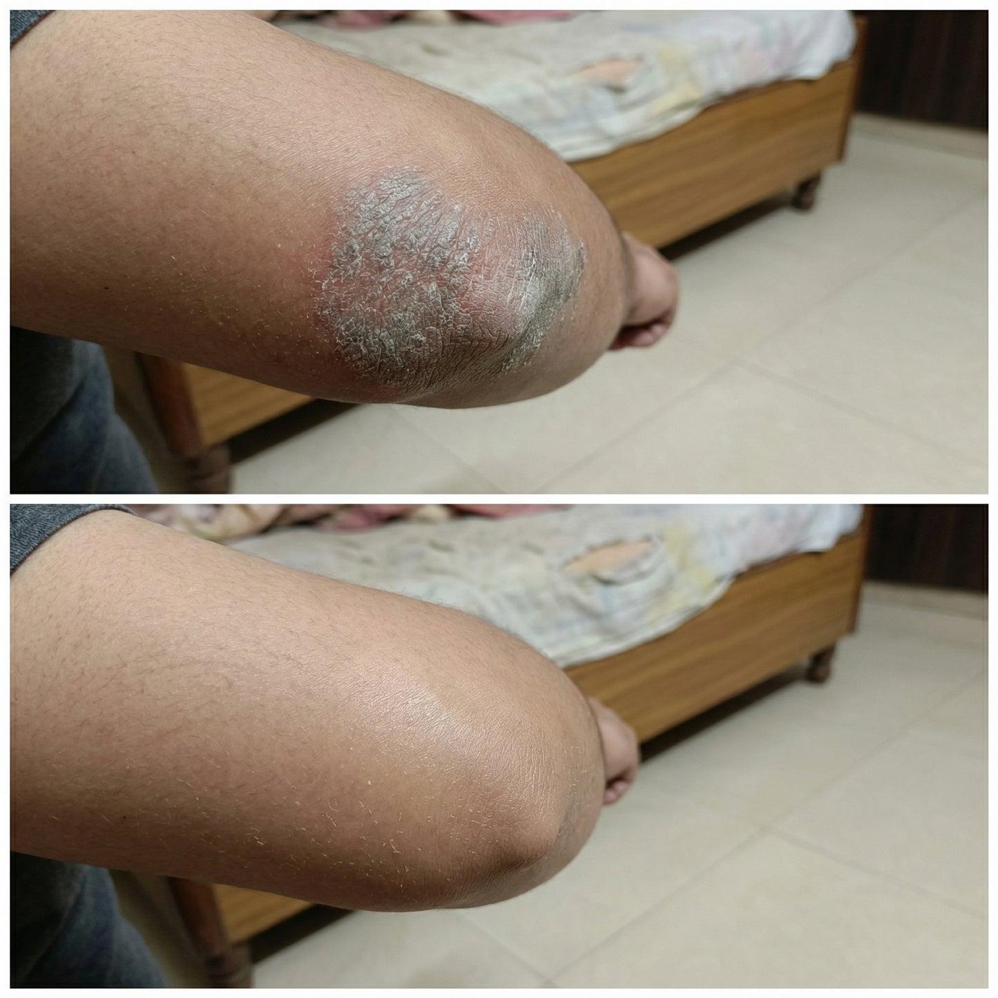 Vedicderm Psoriasis Cream with 2% Bakuchi Extract - New and Improved Pack