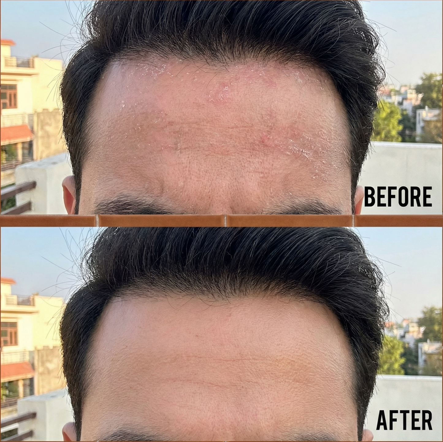 Sensitive Scalp Bundle for Psoriasis, Dandruff, & Itchy Scalp