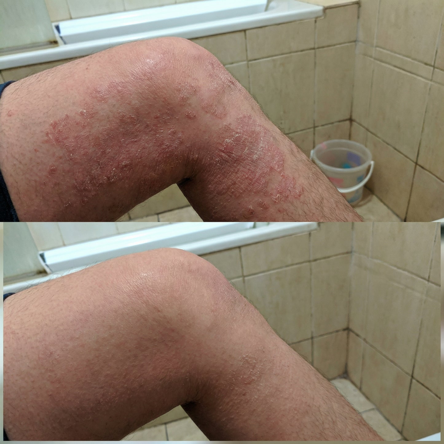 Vedicderm Psoriasis Cream with 2% Bakuchi Extract - New and Improved Pack